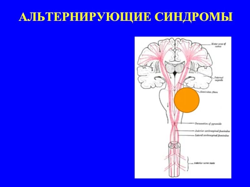 Оптико пирамидный синдром. Альтернирующие синдромы продолговатого мозга неврология. бульбарные альтернирующие синдромы. альтернирующий синдром мийяра-гюблера. альтернирующие параличи.