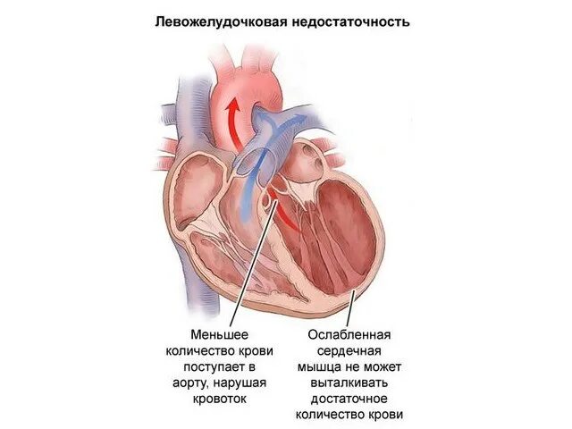 Острая левожелудочковая сердечная недостаточность. Левожелудочковая недостаточность сердца симптомы. Симптомы острой левожелудочковой сердечной недостаточности. Острая правожелудочковая недостаточность схема. Сердечная недостаточность схема