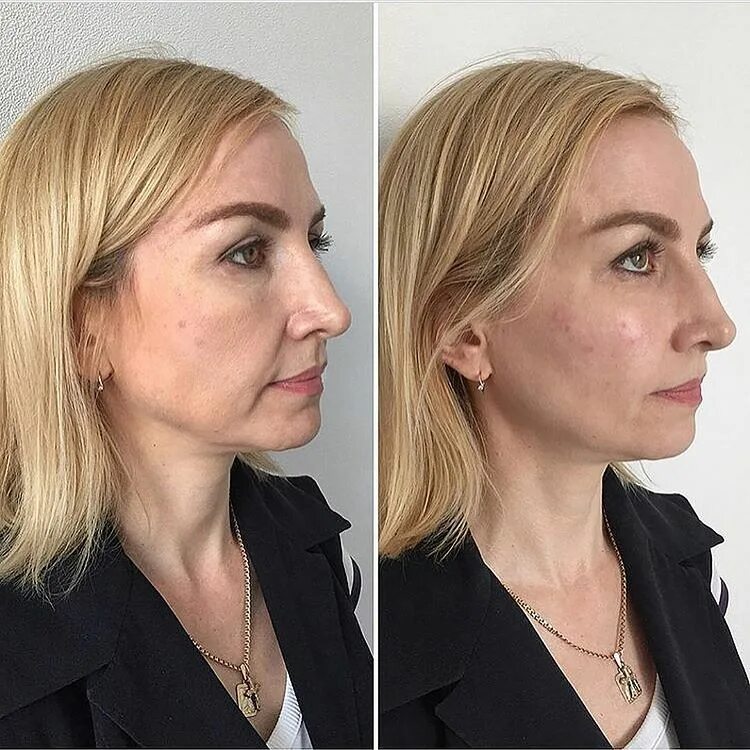 ограничения после филлеров. пластика скул гиалуроновой кислотой. ограничения после филлеров. скулы канюлей belotero. скулы до и после.