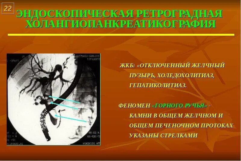 Холедохолитиаз лечение хирургическое. Холедохолитиаз история болезни. Холедохолитиаз история болезни. Жкб план обследования. Осложнения холедохолитиаза.