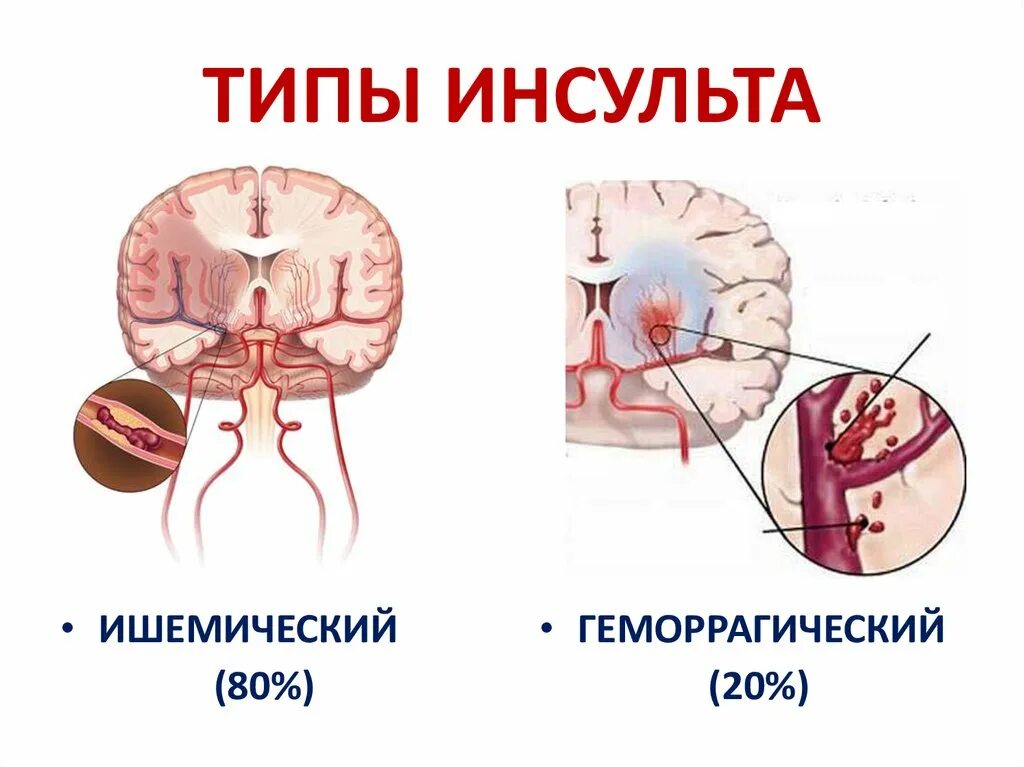 Ковид инсульт. Инсульт картинки. Ишемический инсульт головного мозга у пожилых. Ишемический инсульт картинки. Инсульт рисунок.