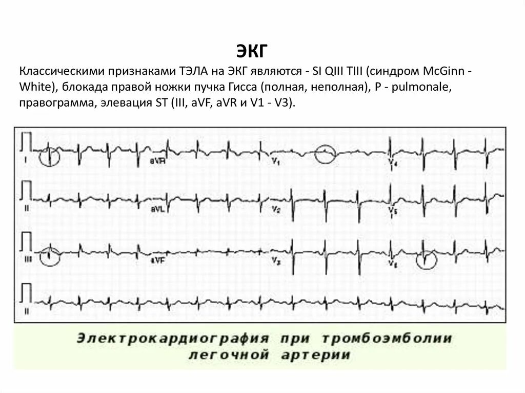 Тромбоэмболия легочной артерии экг. Тэла ЭКГ картина. Изменения на ЭКГ при Тэла. Тромбоэмболия легочной артерии на ЭКГ. Синдром Тэла на ЭКГ.
