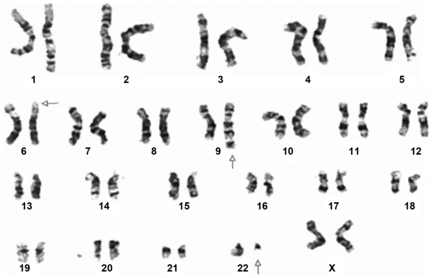 Филадельфийская хромосома кариотип. Кариотип 22х. Кариотип 46 ХХ. Синдром Клайнфельтера кариотип.