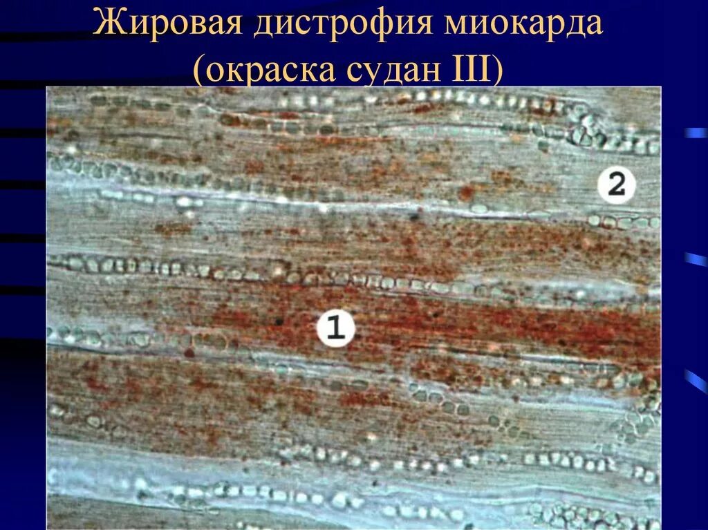 Диффузная дистрофия. Ожирение миокарда патанатомия. Тигровое сердце патанатомия. Жировая дистрофия миокарда микропрепарат Судан 3. Жировая дистрофия кардиомиоцитов гистология.