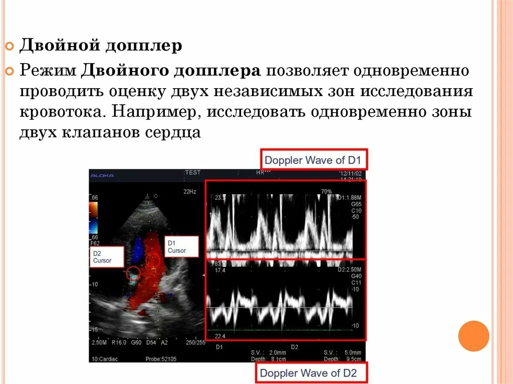 Что определяет доплер. Ультразвуковая высокочастотная допплерография. Импульсно волновая допплерография. Импульсный допплер ЭХОКГ. Ультразвуковые исследования допплерография доклад.