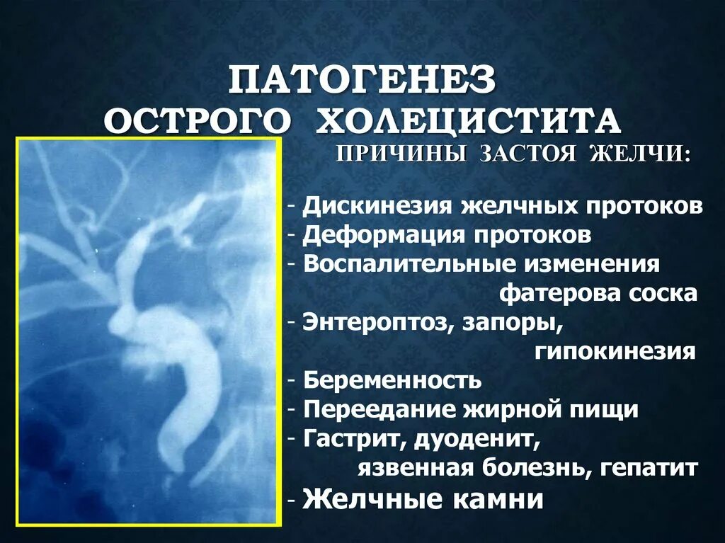 Застой желчного пузыря у взрослого симптомы. Механизм развития острого холецистита. Патогенез острого холецистита. Факторы застоя желчи. Острый холецистит этиопатогенез.