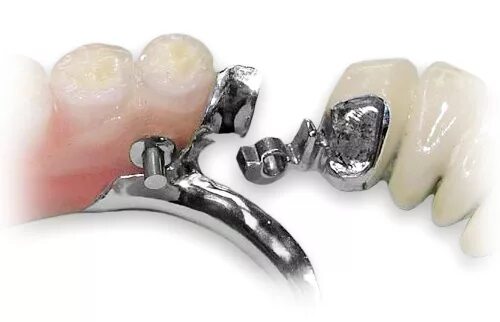 Бюгельный протез аттачмены. Бюгельный протез на телескопических коронках. Бюгельный протез а16. Кламмерная система фиксации бюгельных протезов. Замок бредент на бюгельный протез.