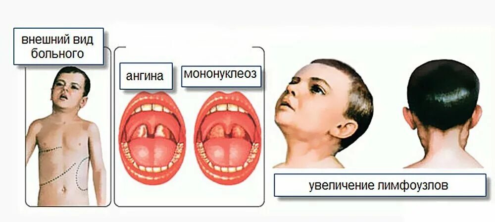 Прививка от ангины