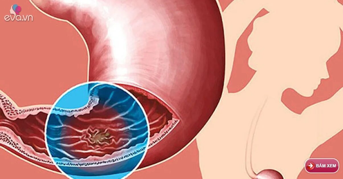 Метастазы печени кт брюшной полости. Метастазы в желудке прогноз. Онкология желудка 4 стадия. Метастазы в желудке прогноз. Опухолевые новообразования жкт.