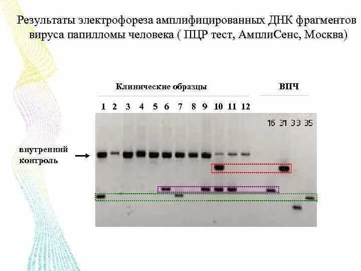 Тест песня электрофорез. Электрофореграмма результатов ПЦР. Детекция результатов ПЦР электрофорез. Электрофорез ДНК. Метод ПЦР гель электрофорез.