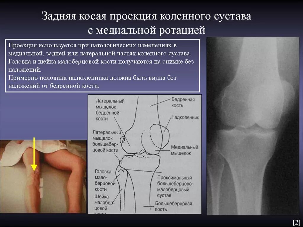 Задняя проекция коленного сустава. Дисплазия внутреннего мыщелка бедренной кости. Рентгенография коленного сустава (2 проекции). Рентгенограмма коленного сустава в задней проекции. Контузионные изменения кости