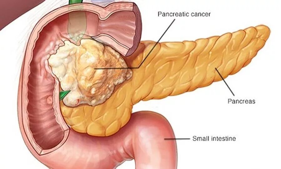 Панкреатит головка. 12 Перстная кишка Фатеров сосочек. Карцинома поджелудочной железы. Поджелудочная железа бдс опухоль.