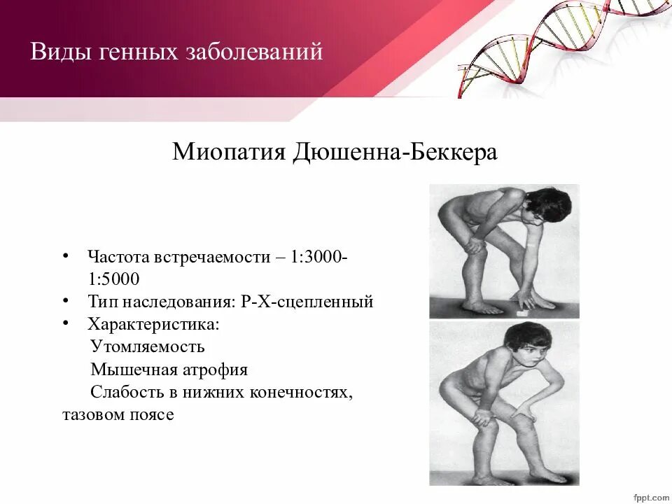 Клиническая миопатия. Псевдогипертрофическая миопатия Дюшенна. Миопатия Дюшенна частота заболевания. Миодистрофия Дюшенна Тип наследования. Мышечная дистрофия Дюшенна-Беккера Тип наследования.