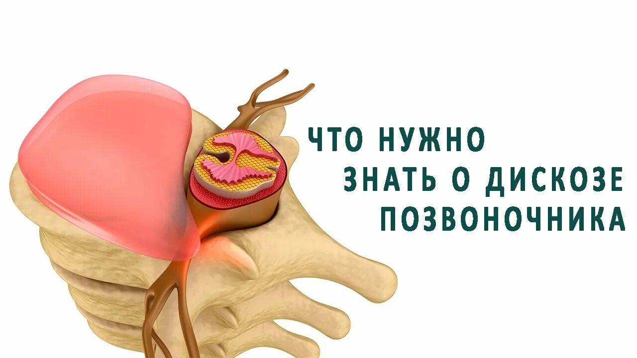 Дискоз шейного отдела позвоночника. Протрузия межпозвонкового диска c5-c6. Дискоз позвоночника. Дискоз позвонков что это. Disc bulging.