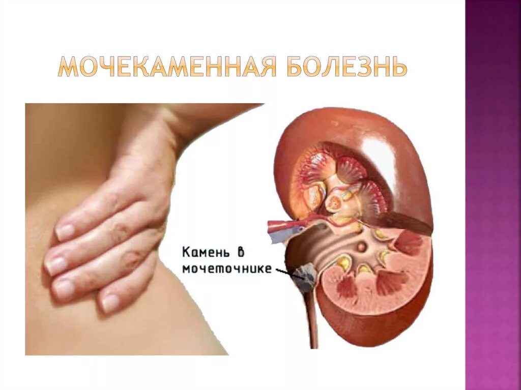 Почечно-каменная болезнь почечная колика. Мочекаменная болезнь почечная колика. :Мочекаменная болезнь,почечный коллек. Мочекаменная болезнь камень лоханки левой почки.