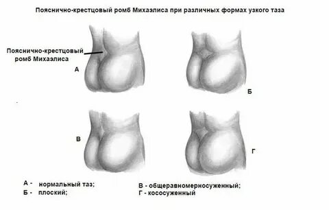 Ромб михаэлиса размеры