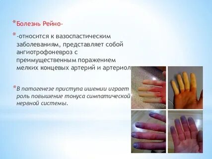Болезнь рейно мкб