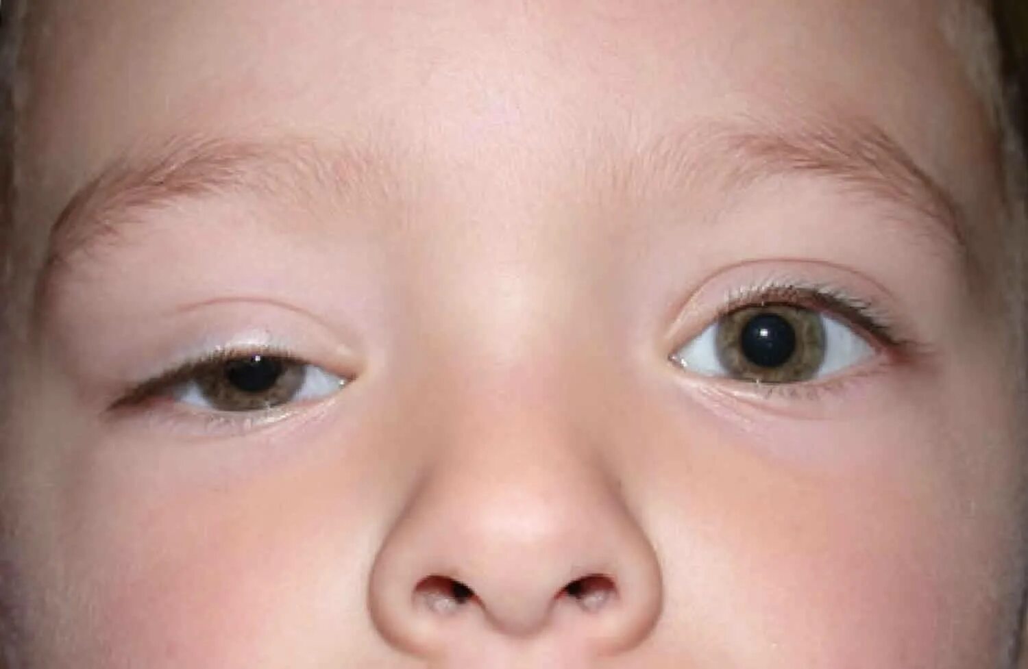 Botulinum Toxin Injection for Facial Wrinkles AAFP