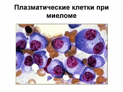 Миеломная болезнь лейкоз