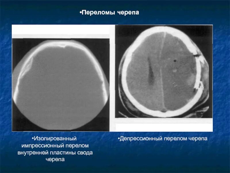 Перелом кости свода черепа. Импрессионный перелом черепа на кт. Вдавленный перелом теменной кости рентген. Вдавленный перелом черепа теменной кости. Перелом теменной кости рентген.