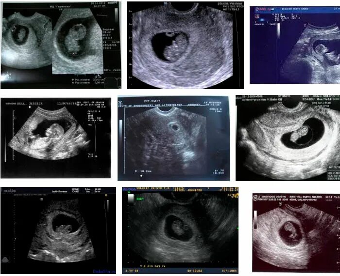 8 недель и 6 дней. УЗИ на 7-8 акушерской неделе беременности. УЗИ на 8 неделе беременности акушерской. УЗИ беременности 8 недель беременности. Эмбрион 8 недель УЗИ.