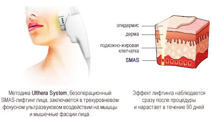 Схема ультразвукового смас лифтинга. Смас лифтинг на Ulthera System. Смас лифтинг схема по зонам. Аппаратная подтяжка лица смас-лифтинг. Что лучше смас или рф