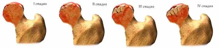 Доа тазобедренного сустава 2 степени. Доа тазобедренного сустава 2 степени