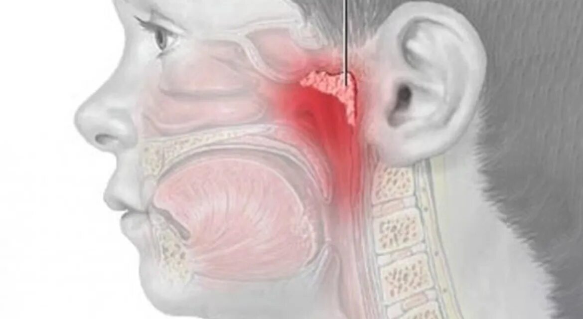 Аденоиды признаки