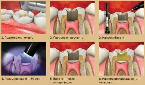 Прокладки при кариесе