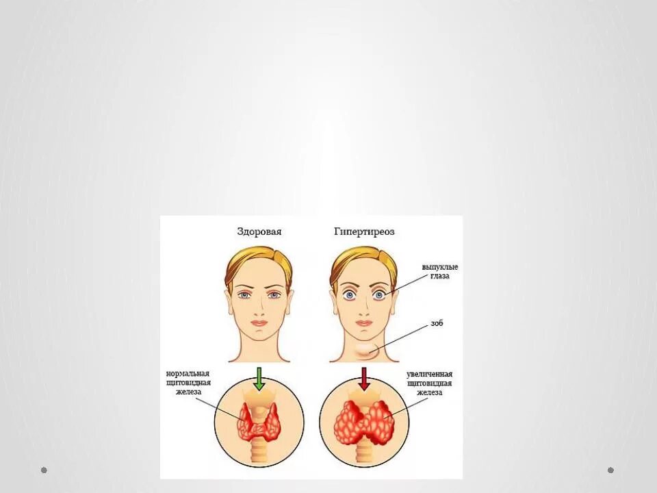 Гипотиреоз нарушение. Гипертиреоз щитовидной железы симптомы у детей. Гипо гипертиреоз щитовидной железы. Тиреотоксикоз щитовидной железы симптомы у мужчин. УЗИ щитовидной железы гипертиреоз.
