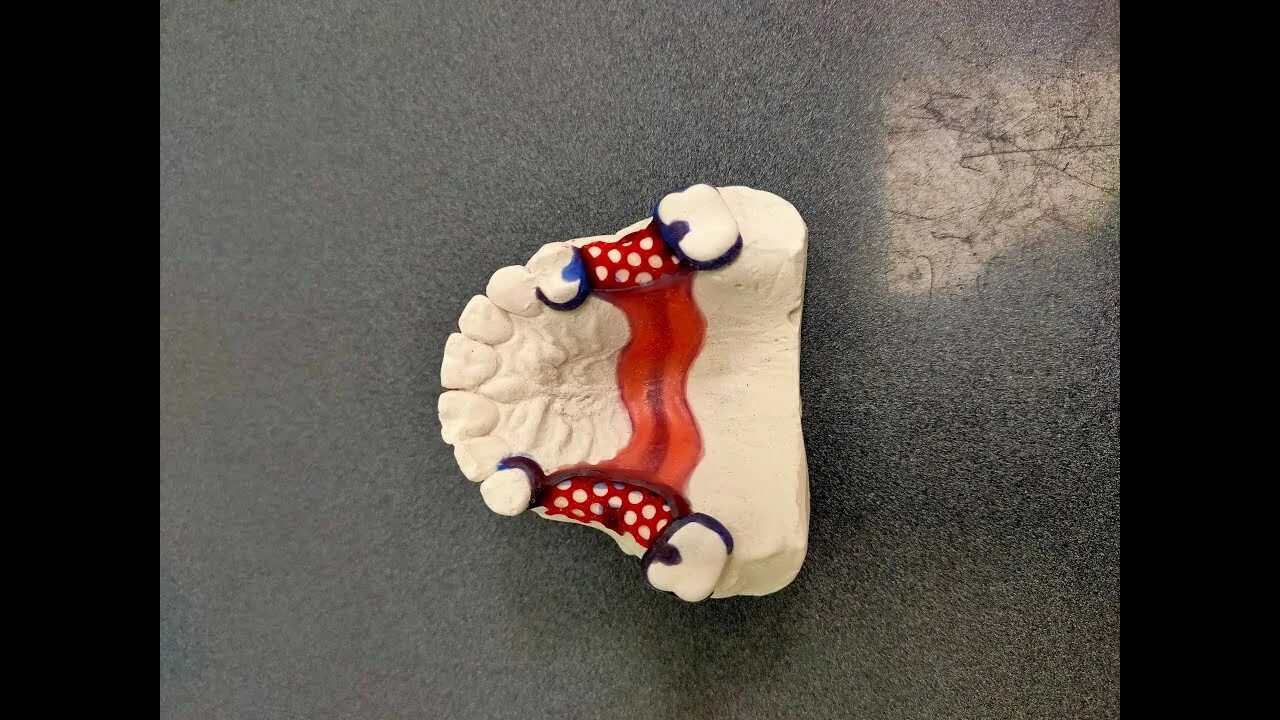 Огнеупорная модель бюгельного протеза. Бюгельный протез моделировка. Ограничитель базиса бюгельного протеза. Каркасное моделирование. Моделировка нижней челюсти бюгель.