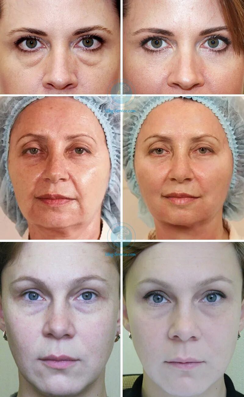 Моделирующий массаж лица до и после. Lpg лица до и после. Массаж лица до и после. Лифтинг массаж лица до и после. Массаж лица до и после.