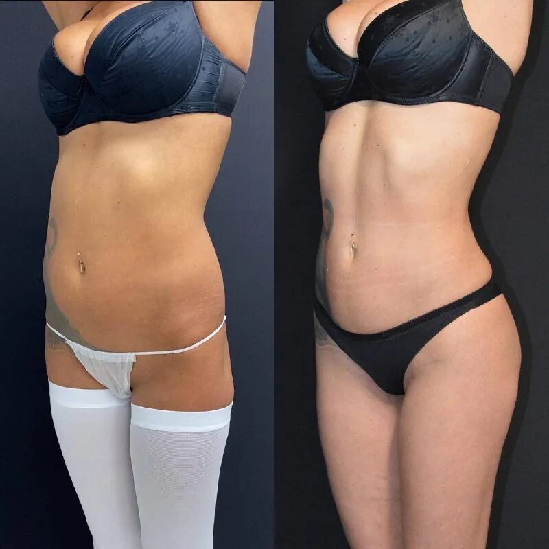 Липофилинг ягодиц форум. Липофилинг внутренней части бедра. Липофилинг ягодиц форум. Глютеопластика липофилинг. Липофилинг ягодиц форум.