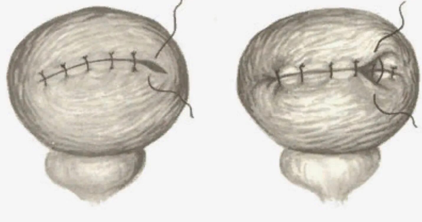 После операции тур мочевого пузыря. Ушивание мочевого пузыря техника операции. Ушивание раны мочевого пузыря. Ушивание стенки мочевого пузыря.
