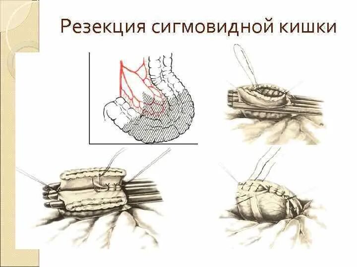 Что делать после операции на кишечнике. Резекция сигмовидной кишки операция. После операции на резекцию сигмовидной кишки. Резекция сигмовидной и прямой кишки. Лапаротомия сигмовидной кишки.