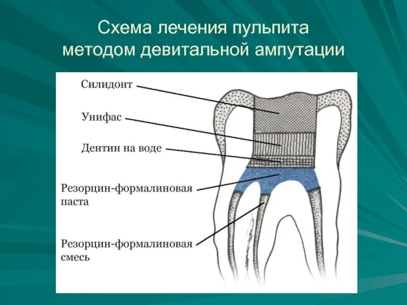 Метод ампутации пульпы. Методика девитальной ампутации пульпы. Метод девитальной ампутации пульпы схема. Пульпит метод витальной ампутации. Методика. Витальная ампутация пульпы методика.