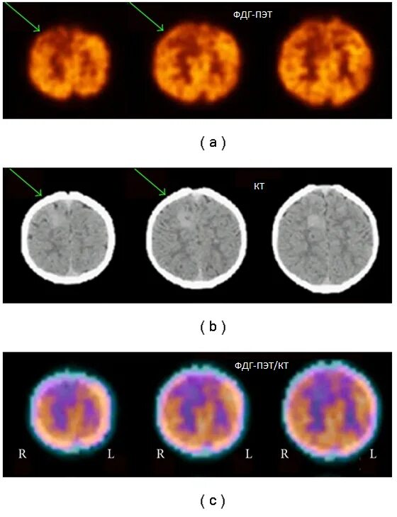 фдг при пэт кт что это