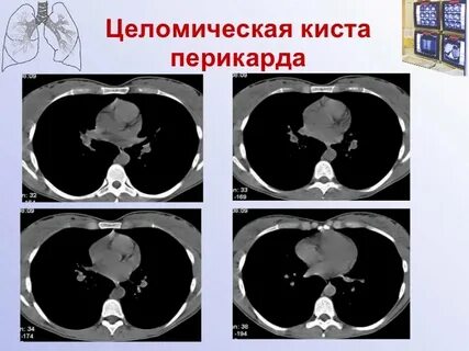 Киста перикарда