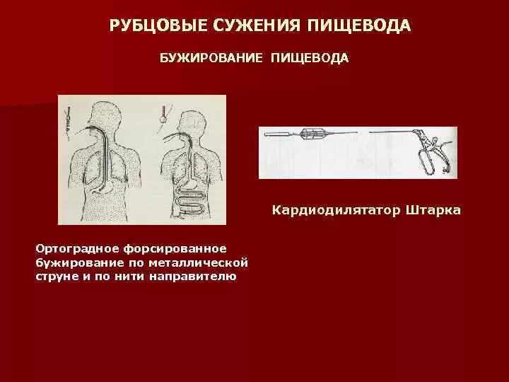 Рубцовые сужения пищевода