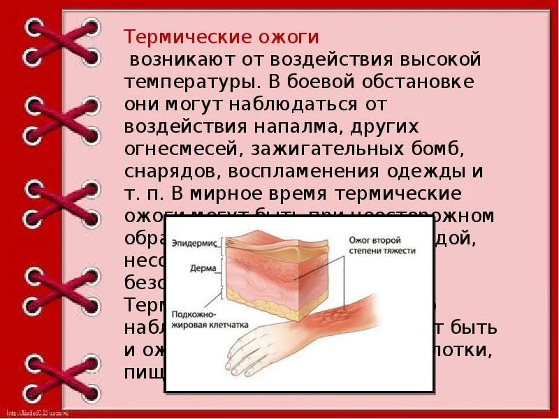 Ожоги обж 8 класс. Степени ожога презентация.