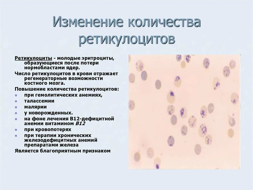 Ретикулоциты в периферической крови. Ретикулоциты мазок крови. Уровень ретикулоцитов при гемолитической анемии. Ретикулоциты анализ крови анемия. Ретикулоциты повышены у мужчины