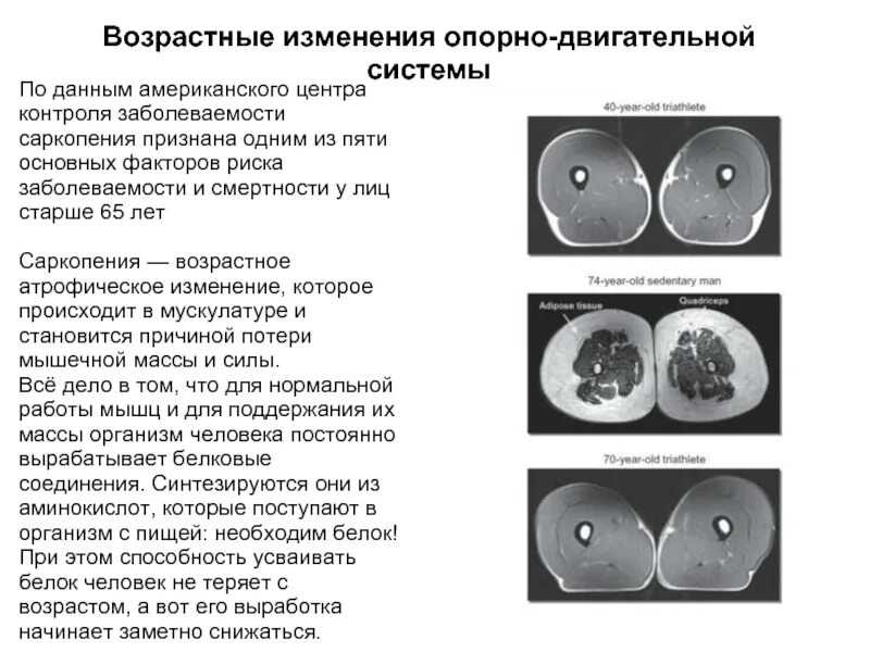 Саркопения это простыми словами. Возрастные изменения. Старческая саркопения. Саркопения у пожилых саркопения у пожилых. Диагностические критерии саркопении.