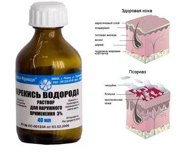 Псориаз домашнее лечение отзывы