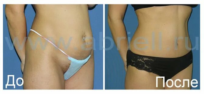 Ocean Clinic Абдоминопластика Марбелья Испания