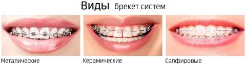 Металлические или керамические