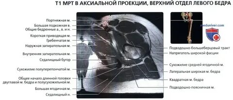 Тендинит средней ягодичной
