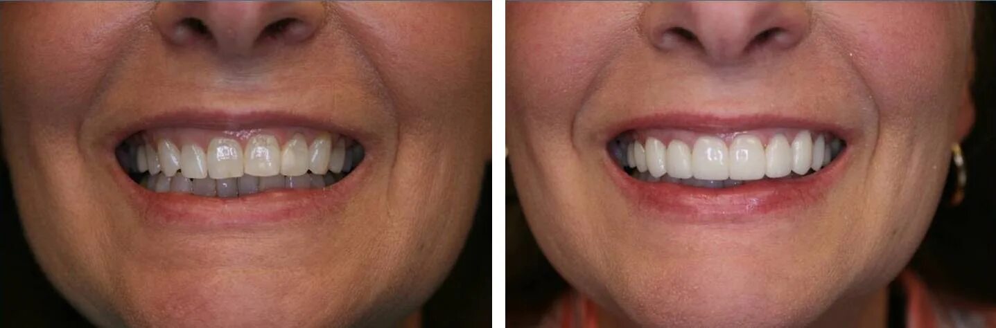 как снять виниры