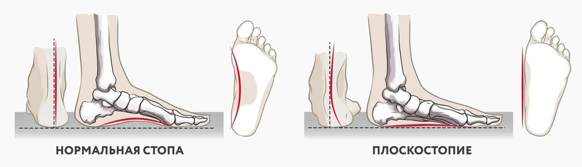 Поперечное 1 степени. Свод стопы плоскостопие. Плоскостопие и полая стопа. Поперечный свод стопы анатомия.