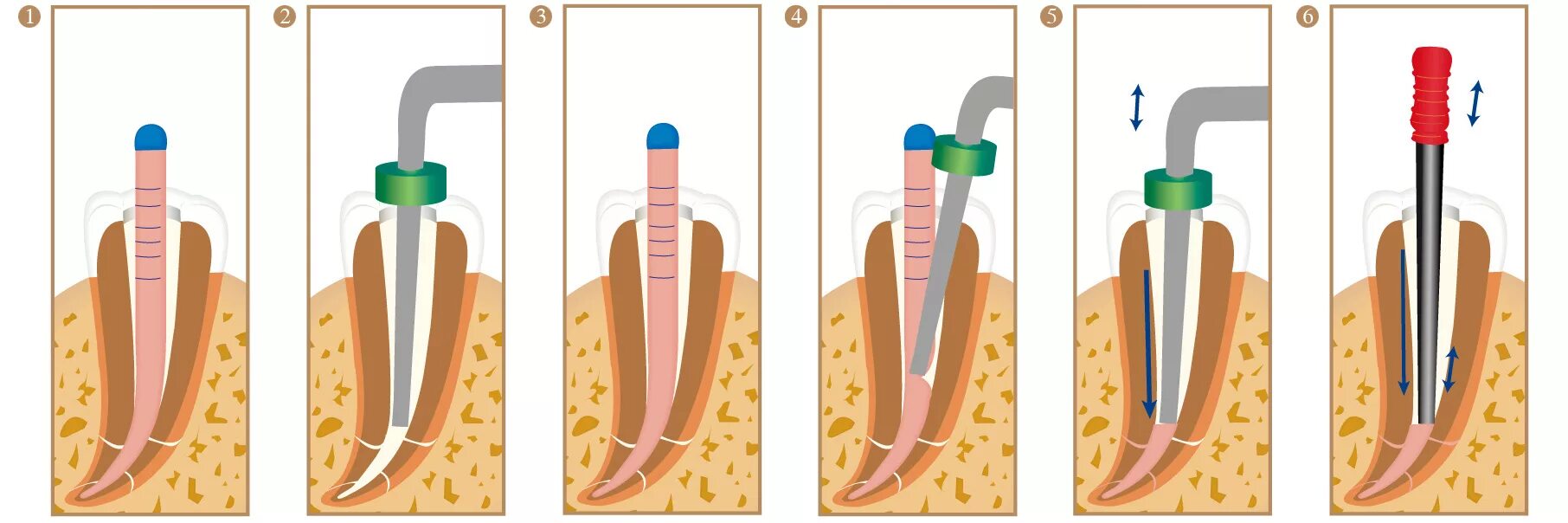 пломбирование зуба гуттаперчевыми штифтами. метод латеральной конденсации для пломбирования корневых каналов. пломбирование зуба гуттаперчевыми штифтами. штифты для пломбировки корневых каналов. пломбирование зуба гуттаперчевыми штифтами.