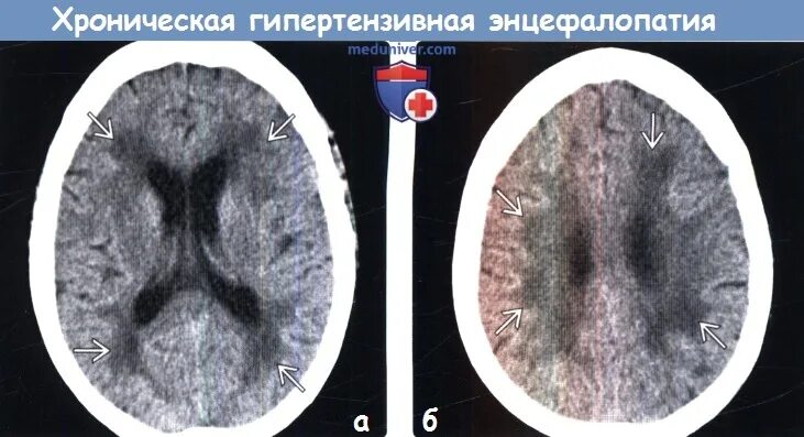 Гиподенсные очаги в головном мозге на кт. Гиподенсные очаги головного мозга. Гиподенсивный очаг в головном мозге. Гиперденсивный очаг головного мозга. Гиподенсные очаги головного мозга.